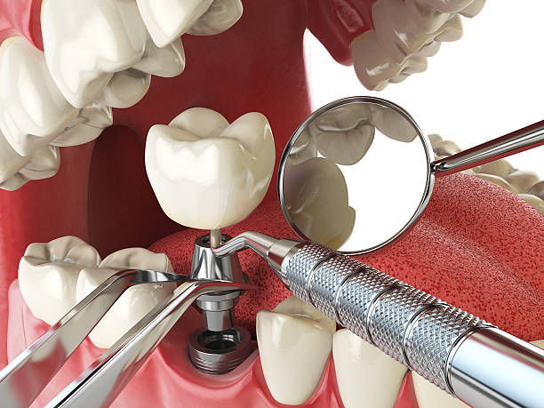 Best Knocked-Out Tooth Emergency  in Miami, FL